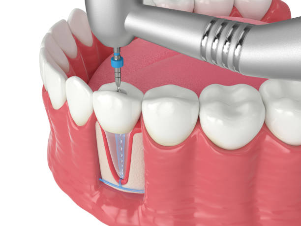 Dental fillings